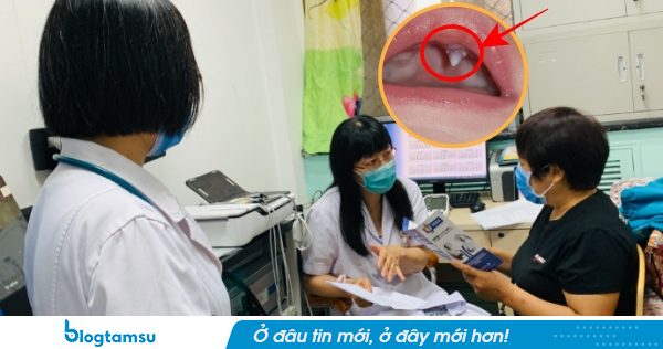 Con 3 tháng tuổi không ngừng khóc, mẹ phát hoảng khi thấy trong miệng con mọc răng nanh, đến bệnh viện bác sĩ lắc đầu