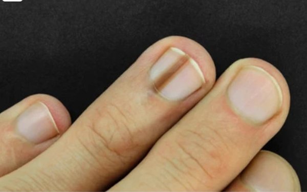 Bác sĩ bệnh viện trung ương cảnh báo: 5 dấu hiệu trên móng tay cần nghĩ tới UT ác tính