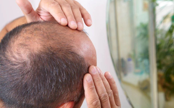 Ăn 3 quả trứng sống mỗi ngày để cứu mái tóc đang rụng, người đàn ông nhận cái kết bất ngờ