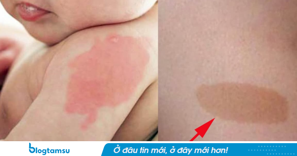 Đứa trẻ sở hữu vết bớt ở 10 vị trí này trên cơ thể báo hiệu tương lai sung túc, tài lộc dồi dào