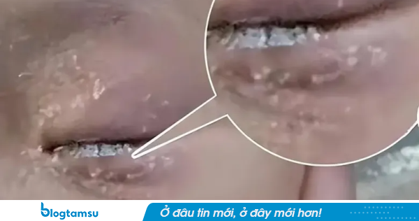 Bé 3 tuổi nhỏ keo 502 vào mắt, bố bình tĩnh cứu nguy trong 60 giây khiến bác sĩ cũng nể phục