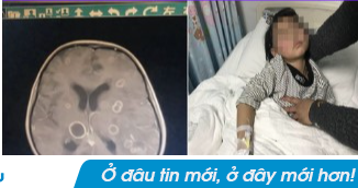 Bé gái lớp 2 não 