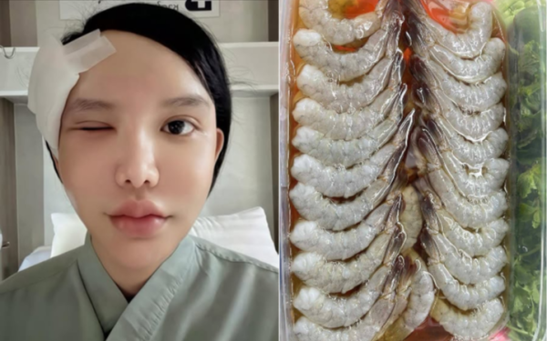 Người phụ nữ bị ký sinh trùng bò vào hốc mắt, suýt mù, bác sĩ cảnh báo 1 thói quen nhiều người Việt mắc phải