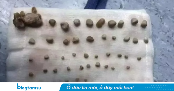 Ngỡ ngàng lấy ra 56 viên sỏi trong thận bé trai lớp 4, bác sĩ nói thẳng: Bố mẹ chiều sai cách!