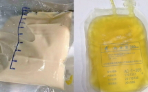 Cô gái 27 tuổi máu đục như trà sữa, ngập dầu vì 1 thói quen ăn uống người trẻ Việt nào cũng mắc