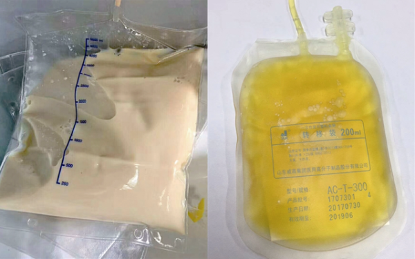 Cô gái 27 tuổi máu đục như trà sữa, ngập dầu vì 1 thói quen ăn uống người trẻ Việt nào cũng mắc