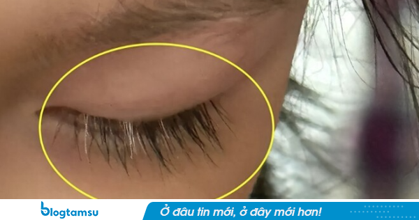 Mẹ phát hiện con gái tiểu học mọc lông mi màu trắng, đưa đến bệnh viện bác sĩ lắc đầu: 'Quá muộn'