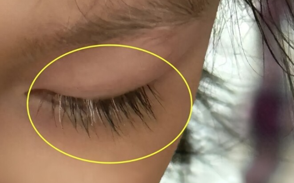 Mẹ phát hiện con gái tiểu học mọc lông mi màu trắng, đưa đến bệnh viện bác sĩ lắc đầu: 