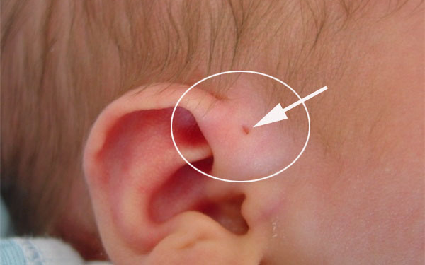 Mẹ phát hiện gần tai con xuất hiện một lỗ sâu khác thường liền tò mò bóp thử, không ngờ bác sĩ yêu cầu phẫu thuật ngay