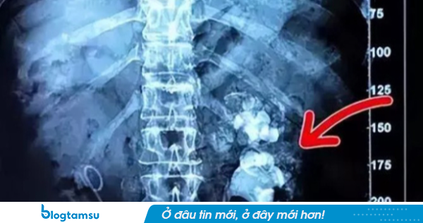 Uống gần 3.000 cốc trà sữa thay nước lọc, cô gái bị sỏi kín hai quả thận