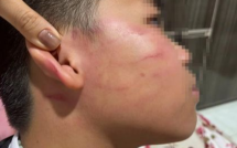 Học sinh lớp 4 bị thầy giáo tác động th:ủng m:àng nh:ĩ, phải chuyển viện