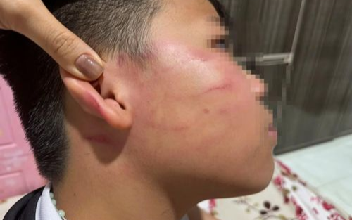 Học sinh lớp 4 bị thầy giáo tác động th:ủng m:àng nh:ĩ, phải chuyển viện
