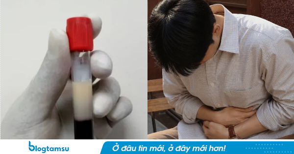 Người đàn ông 28 tuổi máu ngập mỡ, nhớt như dầu: Tất cả tại 2 món khoái khẩu và 2 loại nước 