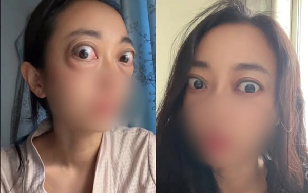 Nhìn đôi mắt "ếch" của người phụ nữ, ai cũng thương, câu chuyện phía sau là bài học cảnh tỉnh nhiều người trẻ