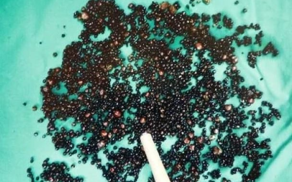 Đau bụng suốt nhiều tháng, người đàn ông 43 tuổi sốc nặng khi bác sĩ gắp ra thứ "đáng sợ" bên trong bụng
