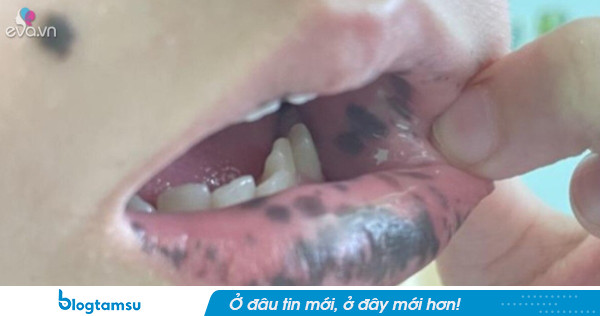 Môi con gái 10 tuổi bỗng xuất hiện nhiều đốm đen, gia đình sững sờ khi biết nguyên nhân