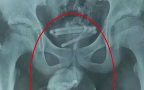 Chàng trai 28 tuổi đau bụng dưới, muốn đi tiểu nhưng không thể đi được, bác sĩ kiểm tra phát hiện 1 thứ dài 25cm bên trong
