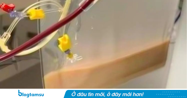 Người phụ nữ ngoài 30 tuổi máu trắng như sữa sau khi uống 4 cốc nước 