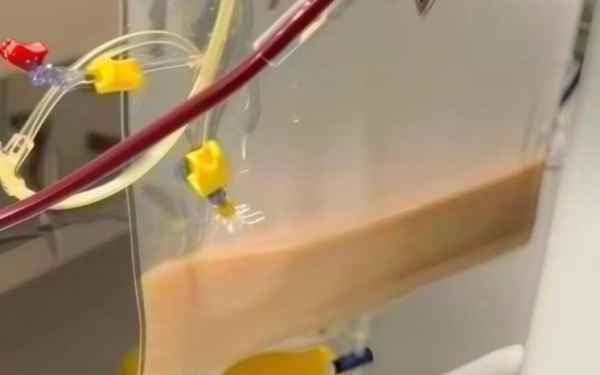 Người phụ nữ ngoài 30 tuổi máu trắng như sữa sau khi uống 4 cốc nước "vạn người mê" trong 1 ngày