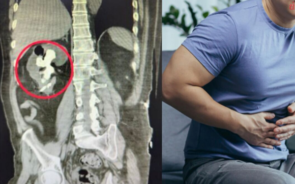Người đàn ông 51 tuổi "thận sỏi như san hô" vì uống thứ nước quen thuộc nhiều người thích