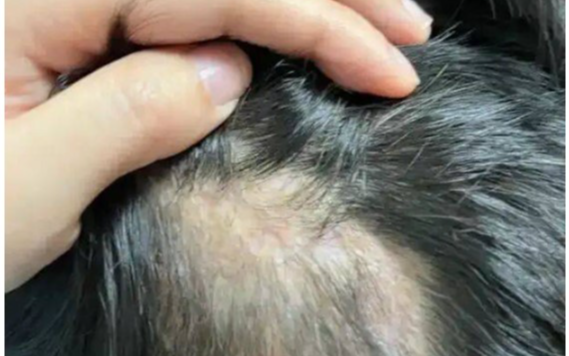 Bé gái 5 tuổi rụng tóc hói vĩnh viễn cả 1 mảng vì 1 hành động tưởng chừng vô hại