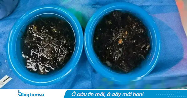 Bé gái 10 tuổi đau bụng suốt 3 năm, bố mẹ sốc khi bác sĩ lấy ra thứ 