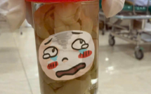 Nhìn qua tưởng hũ dưa chua nhưng đây là sản phẩm lấy ra từ bụng của một người đàn ông Hà Nội