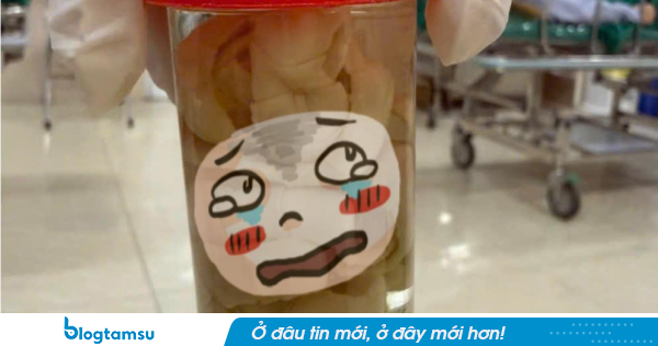 Nhìn qua tưởng hũ dưa chua nhưng đây là sản phẩm lấy ra từ bụng của một người đàn ông Hà Nội