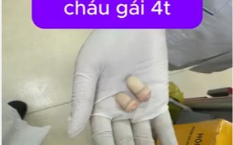 Bác sĩ Xanh Pôn ám ảnh ca bệnh đứt rời 2 ngón tay do máy dập nắp cốc trà sữa, tình trạng hiện tại khiến ai cũng xót xa