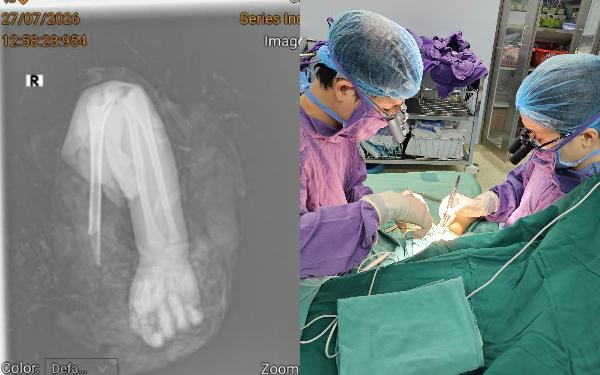 Bé trai 4 tuổi bị đứt rời cánh tay do áo chống nắng, bác sĩ đưa ra khuyến cáo khẩn tới phụ huynh