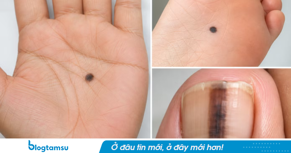 4 điểm mọc chấm đen là dấu hiệu của UT, thường bị nhầm là nốt ruồi