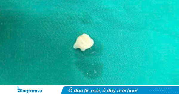 Bà nhổ răng cho cháu bằng sợi chỉ, bé trai 7 tuổi nguy kịch