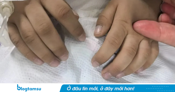 Bé 3 tuổi tím tái, bác sĩ phát hiện ngộ độc nitrit: 6 kiểu đồ ăn thừa cha mẹ nên lưu ý