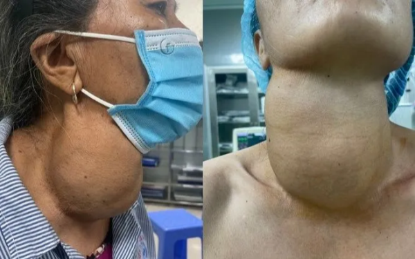 Số lượng người mắc u tuyến giáp ngày càng tăng, bác sĩ nhấn mạnh: Ăn ít cà chua và ăn nhiều hơn 3 loại thực phẩm này