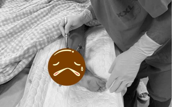 Bé trai bị cổng sập đè đứt chi được bác sĩ ghép tạm bàn tay vào chân