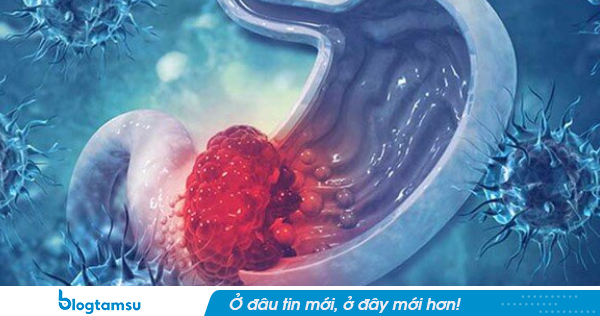 Bác sĩ bệnh viện Bạch Mai cảnh báo: 4 thay đổi bất thường của cơ thể có thể là dấu hiệu ung thư đường tiêu hóa