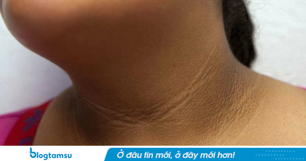 7 dấu hiệu trên khuôn mặt cảnh báo sớm bệnh tiểu đường