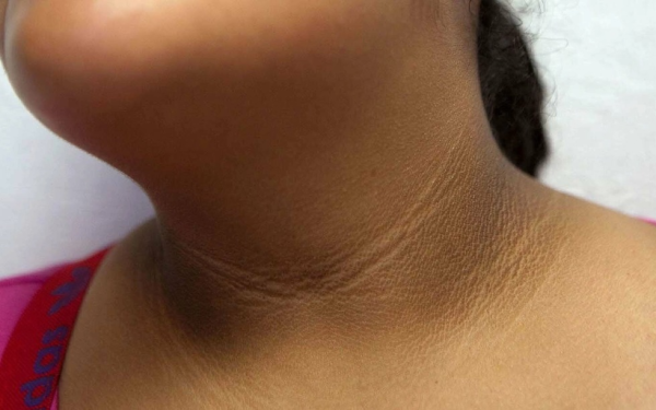 7 dấu hiệu trên khuôn mặt cảnh báo sớm bệnh tiểu đường