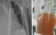 Bác sĩ hút 2,5 lít nước tiểu mỗi ngày từ ngực người phụ nữ sau tai nạn